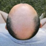hair loss