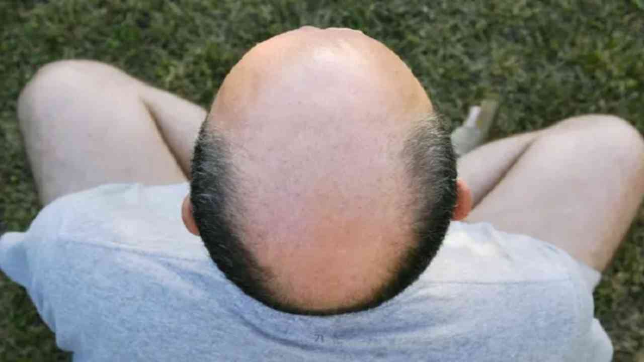 hair loss