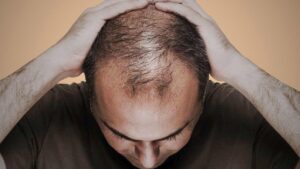 Hair Fall
