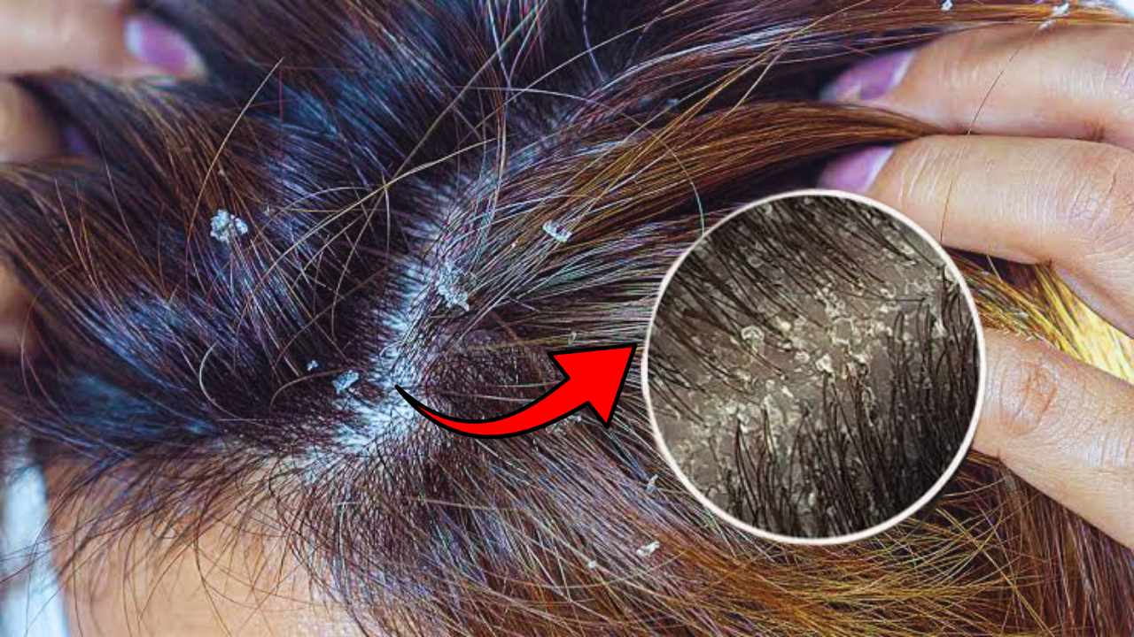 Home Remedies For Itchy Scalp