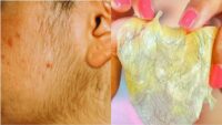 Facial Hair Removal