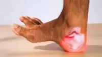 Heel Pain