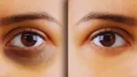 Home Remedies For Dark Circle