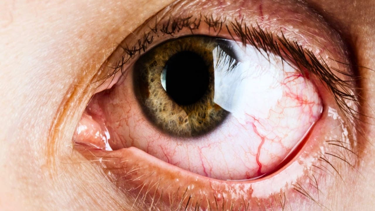 Home Remedies For Dry Eye