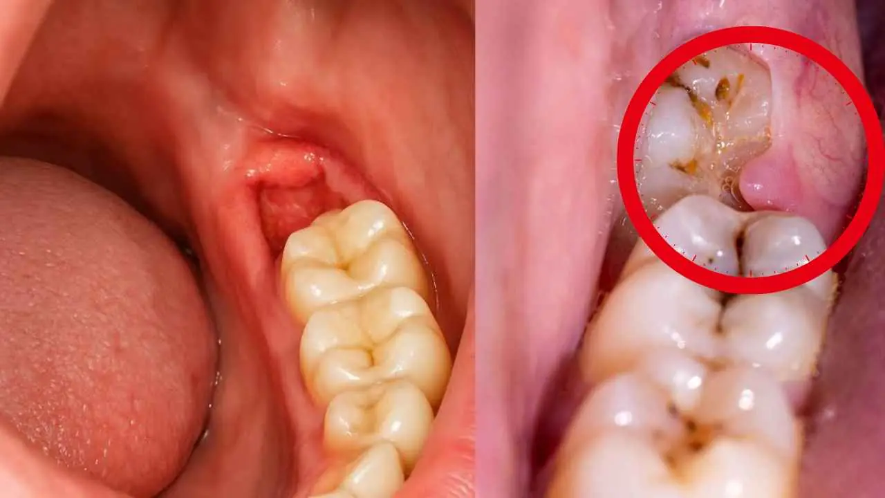 Wisdom Tooth Pain