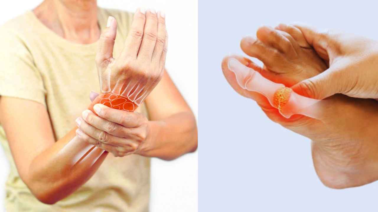 High Uric Acid