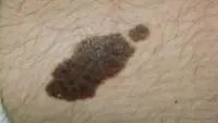 Birthmark Astrology