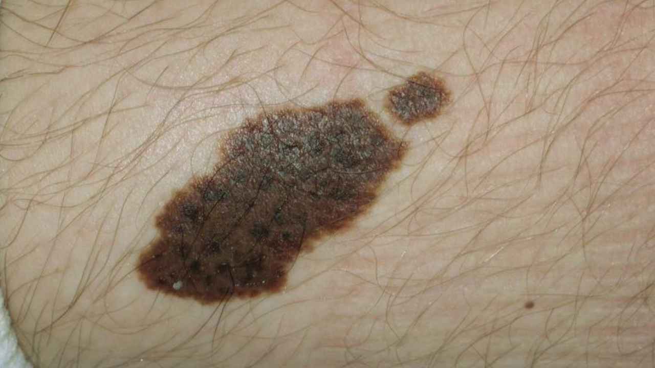 Birthmark Astrology