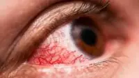 Conjunctivitis