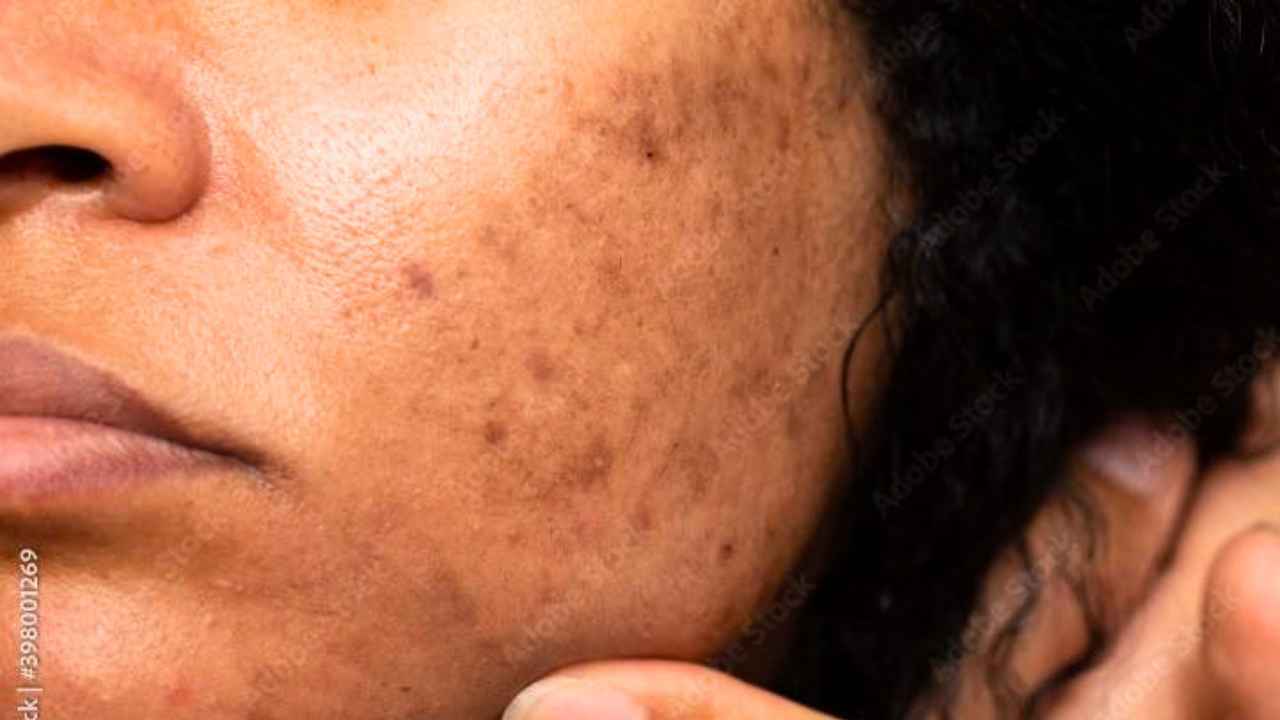 Dark Spot On Face