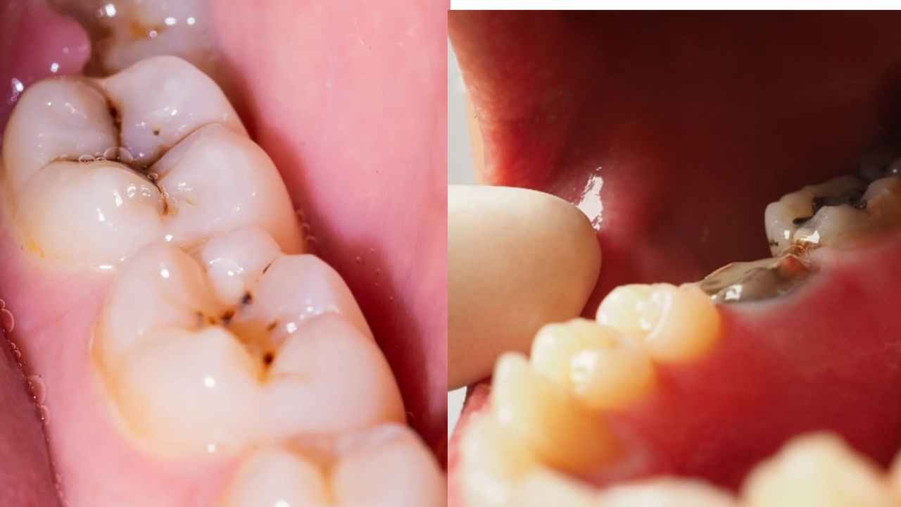 Tooth Cavity