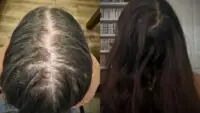 hairfall