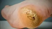 Cracked Heels
