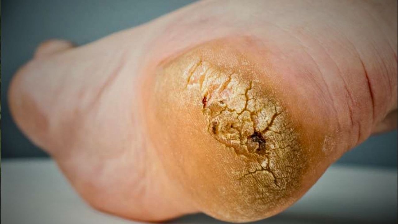 Cracked Heels