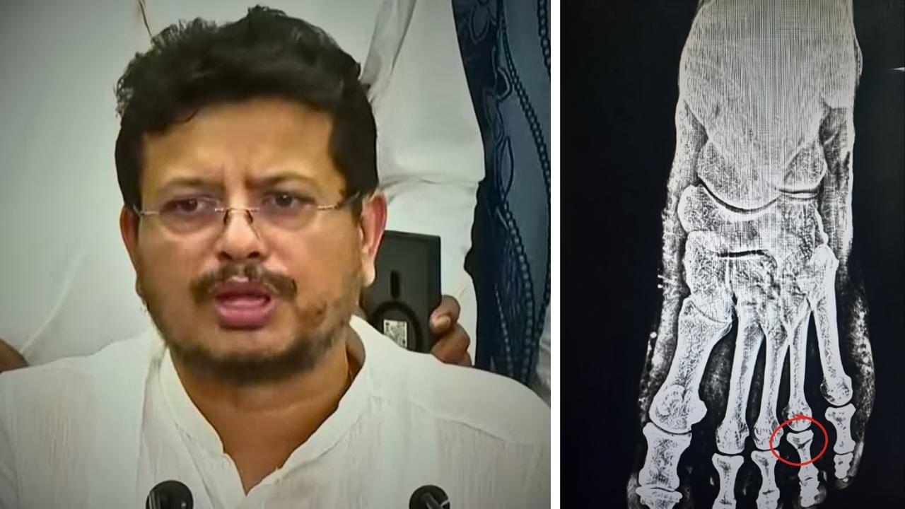 Ritabrata Banerjee Leg Fracture