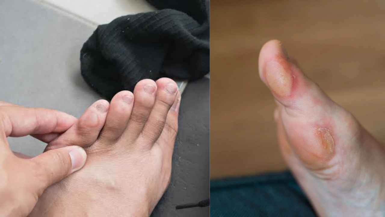 Shoe Blisters