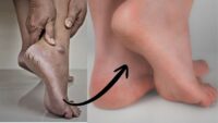 crack heel repair